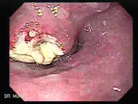 Small Cell Carcinoma of the Lung that Invades the Upper and the Middle Third of the Esophagus - View From the Upper Esophageal Sphincter