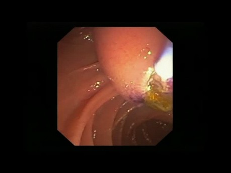 Impacted Stone at the Ampulla - Endoscopic Treatment
