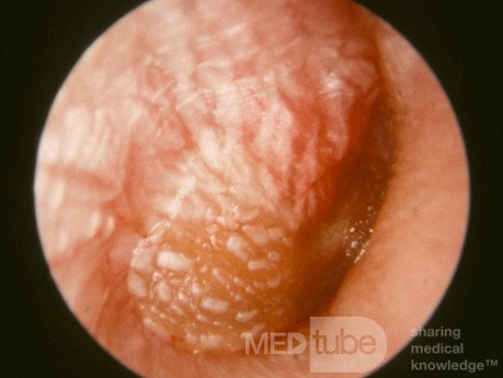 Severe Acute Otitis Media