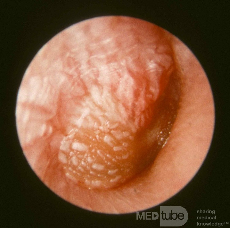 Severe Acute Otitis Media