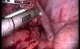 Laparoscopy Due To Pelvic Inflammatory Disease (PID)