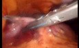 Gastrointestinal Stromal Tumor - GIST (42 of 65)