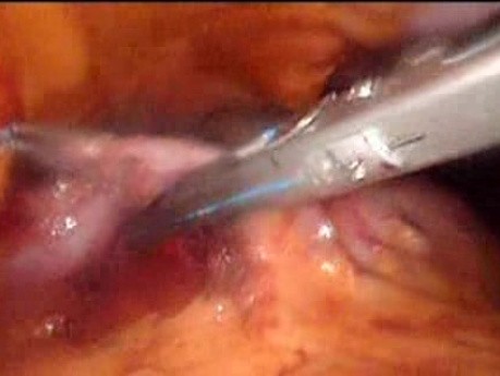 Gastrointestinal Stromal Tumor - GIST (42 of 65)