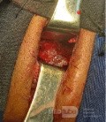 Cloward's Anterior Approach for AO Spine Type C Cervical Fracture with Brown Sequard Syndrome