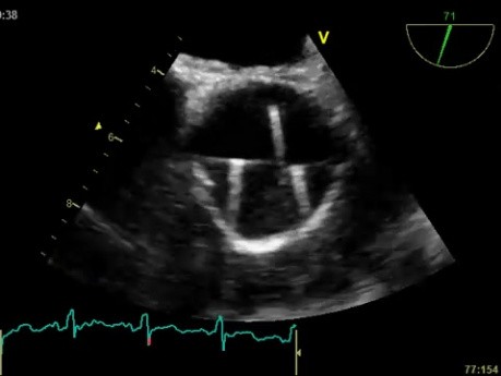 Transesophageal Echocardiography