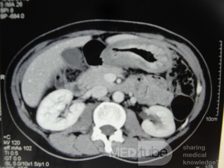Endoscopy of Scirrhous Gastric Carcinoma involving the entire Fundus, Body and the Antrum (22 of 47)