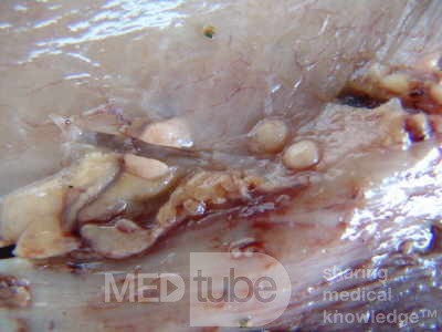 Early Gastric Cancer (13 of 21)
