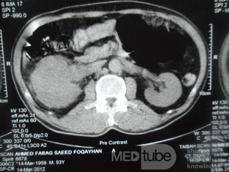 Right Renal Cell Carcinoma