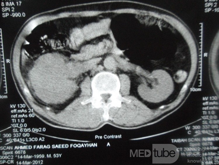 Right Renal Cell Carcinoma