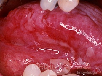 Lichen Planus [major erosive]