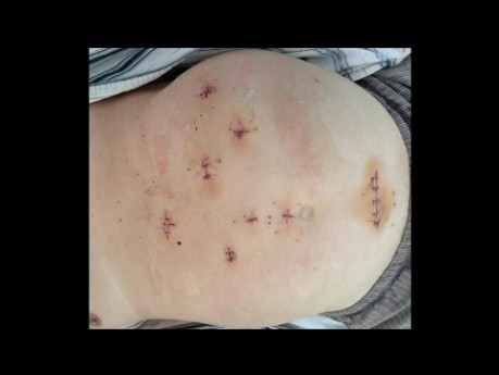 Laparoscopic Left Hepatectomy for Segment III Intrahepatic Cholangiocarcinoma