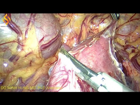 GIST of D3 Duodenum