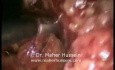 Total proctocolectomy - Laparoscopic Approach