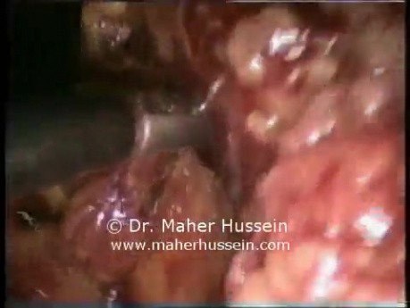Total proctocolectomy - Laparoscopic Approach
