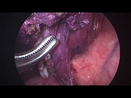 VATS Anatomical Segmentectomy