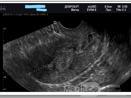 Endometrial Hyperplasia in Ultrasound Procedure - Hysteroscopy