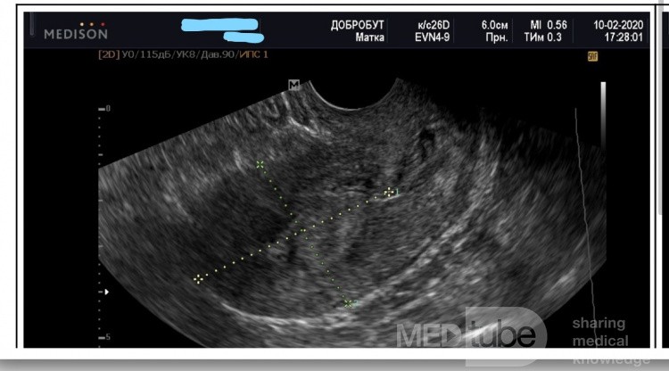 Endometrial Hyperplasia in Ultrasound Procedure - Hysteroscopy