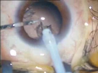 Phacoemulsification