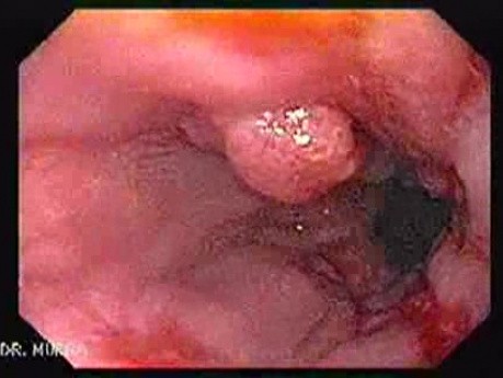 Reflux Esophagitis & Erosions With White Exudate - Esophagoscopy