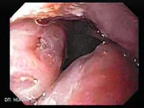 Enlarged Tonsils (1 of 2)