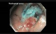 Cecum - Flat Lesion Tethered by Prior Resection - Difficult EMR