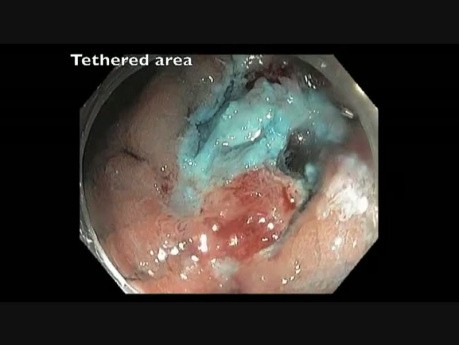 Cecum - Flat Lesion Tethered by Prior Resection - Difficult EMR