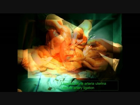 Uterine Artery Ligation During a C-Section