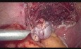  20 x 18 cm Lateral Wall Isthmic Fibroid 