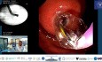 No EUS, Portal Hypertension, and an Urgent Gastric Obstruction. No Problem.