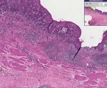 Chronic Esophagitis