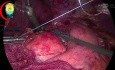 Suturing the Fundus to Rt Crus