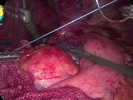 Suturing the Fundus to Rt Crus