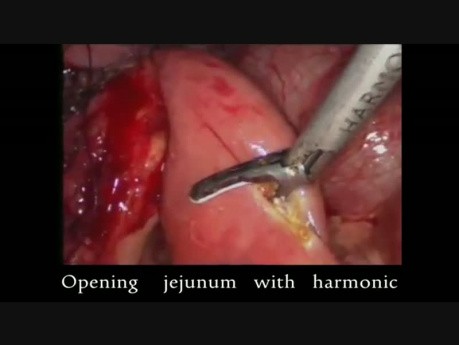 Laparoscopic Pancreaticojejunostomy