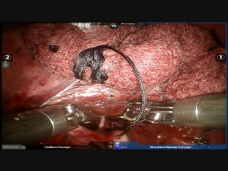 Right Upper Robotic Lobectomy