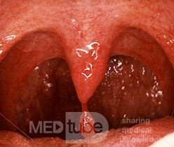 Papiloma e uvula. Papilloma virus - potential cause of oropharyngeal and laryngeal cancers