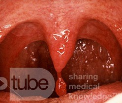 Benign Papilloma of the Uvula