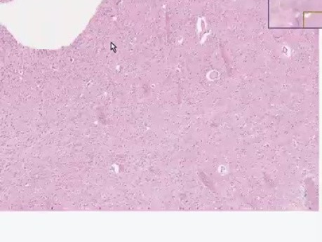 Glioblastoma multiforme - Histopathology - Brain