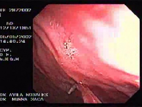 Zollinger- Ellison Syndrome - Gastric Ulcer with Gastrocolic Fistula (13 of 21)