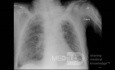 Coronavirus Chest X-Ray (3)