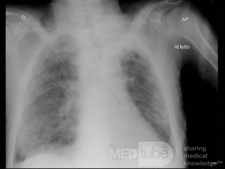Coronavirus Chest X-Ray (3)