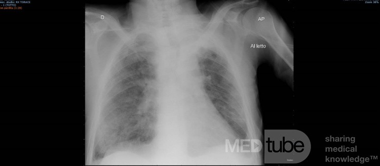 Coronavirus Chest X-Ray (3)