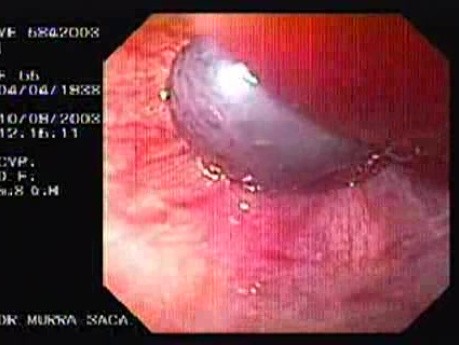 Banding of Esophageal Varices - Ligation of Six Varices