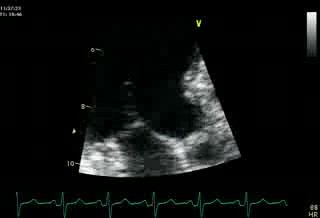 SAM  Mitral  (Incomplete Systolic Anterior Motion Chordae)