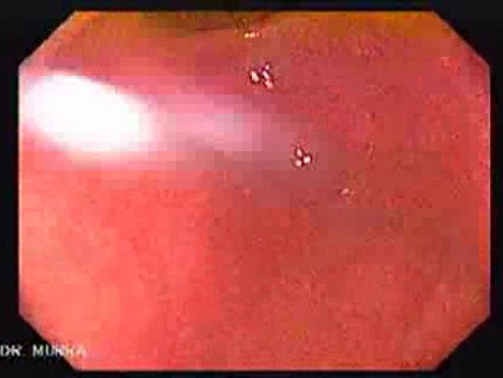 Pylorus And Gastric Antrum - High Resolution Videoendoscopy