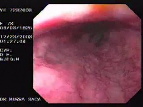 Hemorrhage due status post rubber band ligation of esophageal varices (23 of 25)