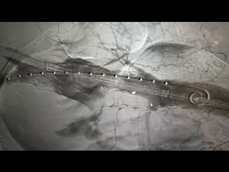 Management of Failed TEVAR with Extravasation Contrast and Conversion
