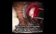 Management of Lost Muscle During Strabismus Surgery