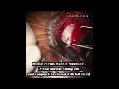Management of Lost Muscle During Strabismus Surgery