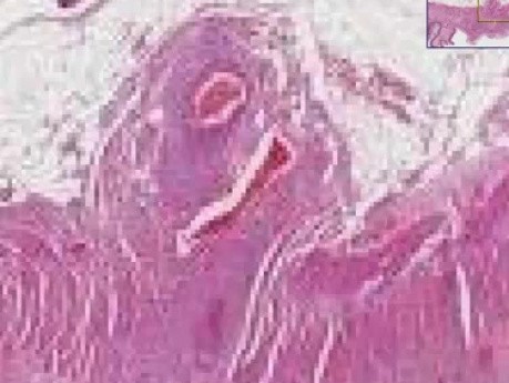 Rheumatoid vasculitis - Histopathology - Small intestine