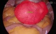 Total Laparoscopic Hysterectomy Intemediate Level